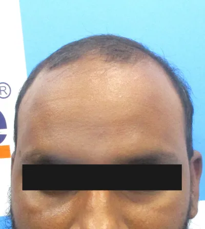 Activated Follicular Transplant Result Before in VCare